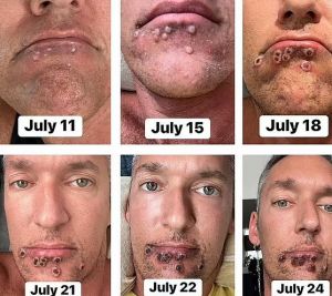 Κρούσμα της ευλογιάς των πιθήκων περιγράφει τον εφιάλτη που έζησε