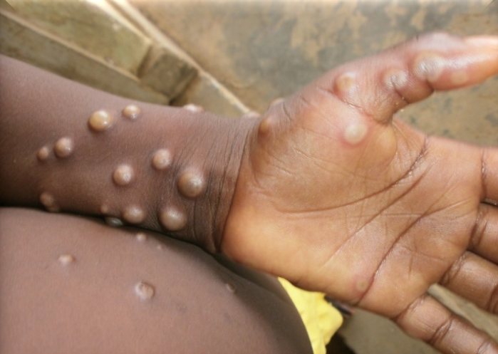 Ευλογιά των πιθήκων: Η ασθένεια μετονομάζεται σε «Mpox»