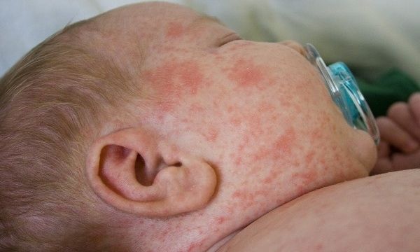 Συναγερμός στην Ευρώπη από την αύξηση κρουσμάτων οστρακιάς