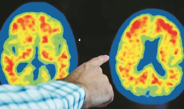 Δύο φάρμακα δίνουν ελπίδα σε ασθενείς με Αλτσχάιμερ