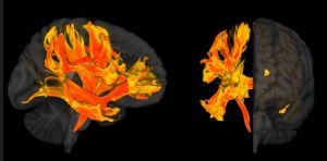 Ερευνητές εντόπισαν περιοχές του εγκεφάλου που επηρεάζονται από την υψηλή πίεση και σχετίζονται με την άνοια