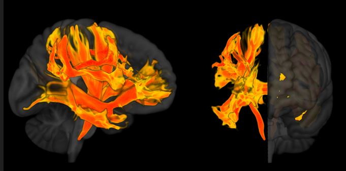 Ερευνητές εντόπισαν περιοχές του εγκεφάλου που επηρεάζονται από την υψηλή πίεση και σχετίζονται με την άνοια | tanea.gr