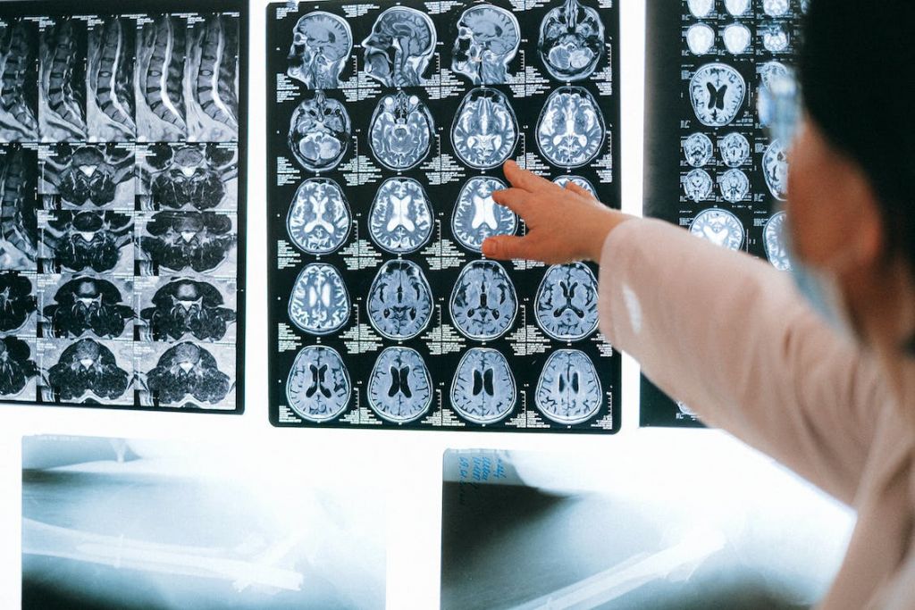Τεχνητή νοημοσύνη με ελληνική συμμετοχή τα βάζει με θανατηφόρο καρκίνο του εγκεφάλου | tanea.gr