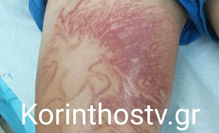 Στο νοσοκομείο 9χρονος που τον τσίμπησε θαλάσσια ανεμώνη