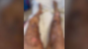 Εξερράγη αποφρακτικό και έπαθε σοβαρά εγκαύματα