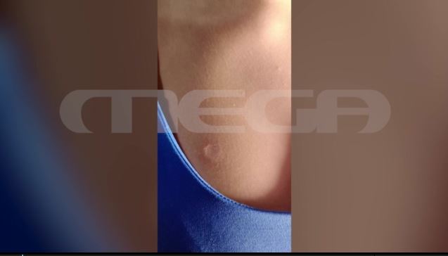 Βία ανηλίκων: Εσβησε το τσιγάρο στο στήθος της 13χρονης φίλης της