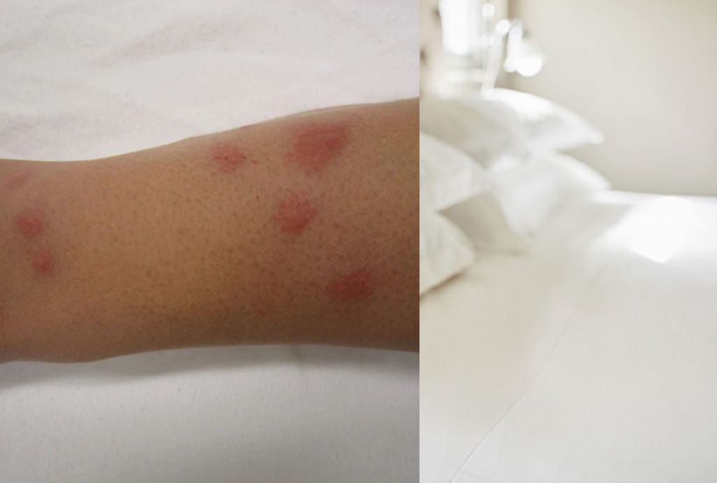 Κοριοί: Νεαρή γέμισε εξανθήματα από δαγκώματα σε ξενοδοχείο της Αττικής