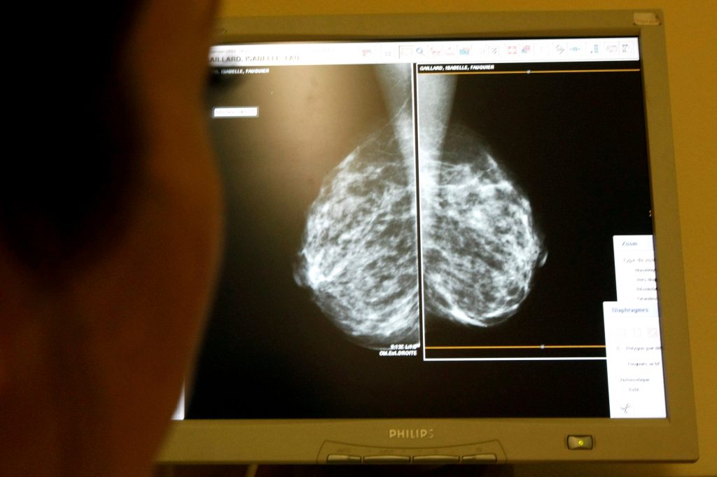 Επέκταση του προσυμπτωματικού ελέγχου για καρκίνο του μαστού στις γυναίκες 45-74 ετών