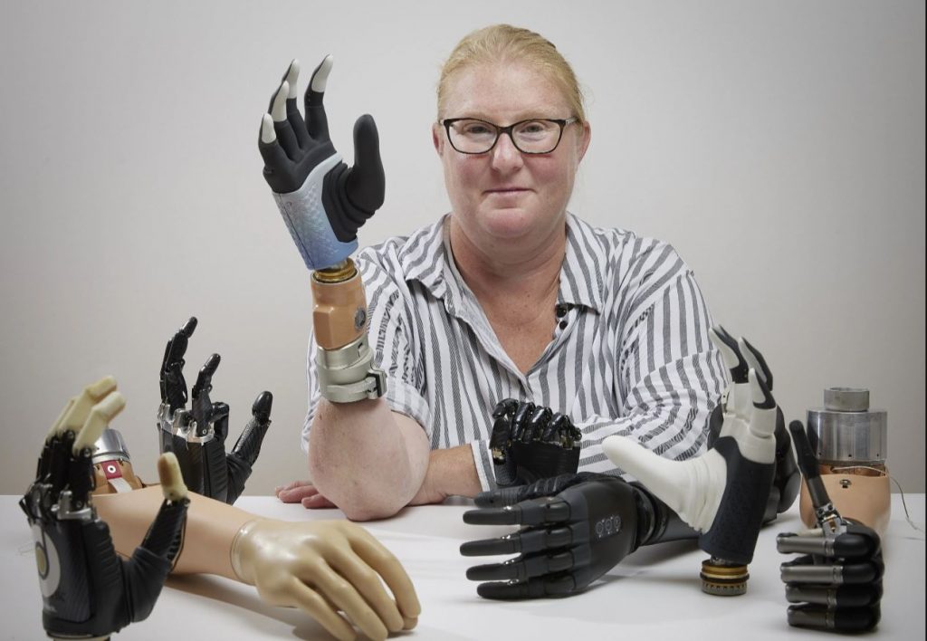 Σουηδή ζει με το πρώτο ρομποτικό χέρι που συνδέεται στον σκελετό