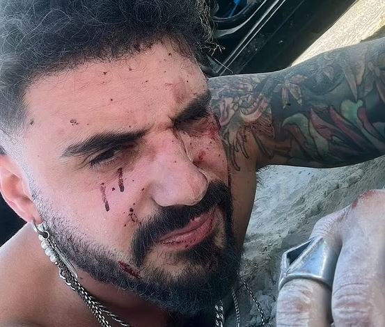 Ισραήλ: 28χρονος περιγράφει πώς επέζησε από το μουσικό φεστιβάλ – «Δέχτηκα δύο σφαίρες στην πλάτη»