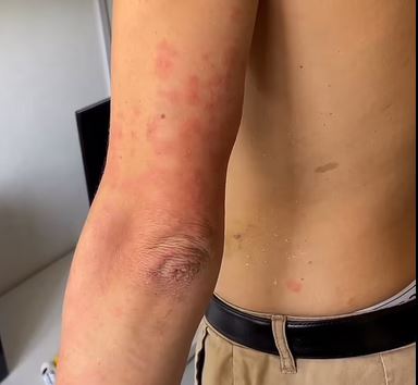 Κόλαση κοριών: Ζευγάρι Αυστραλών γέμισαν δαγκώματα αφού ταξίδεψαν μια νύχτα σε μολυσμένο βαγόνι τρένου