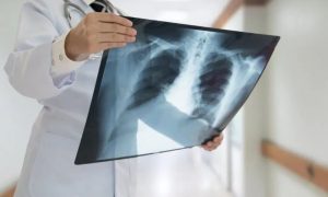 Καρκίνος του πνεύμονα: Εντοπίστηκε άγνωστο μοριακό μονοπάτι για την αναχαίτισή του