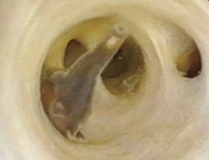 Κίνα: Βίντεο σοκ – Βρέθηκαν σκουλήκια στην κοιλιά 70χρονου