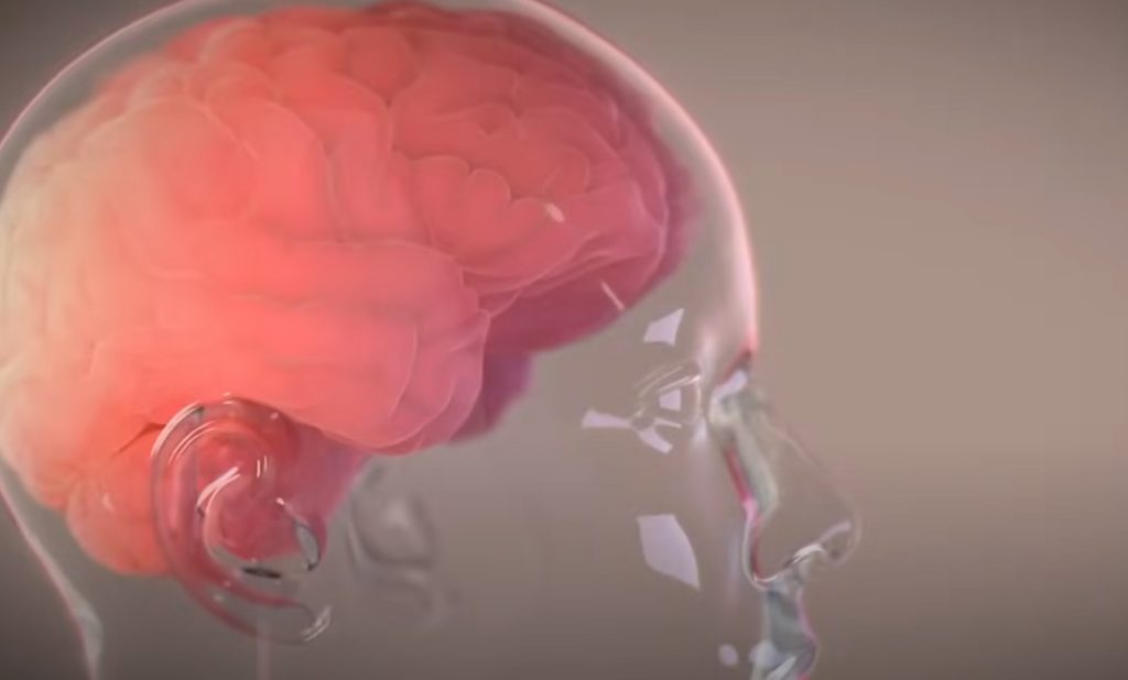 Έλον Μασκ: Ανακοίνωσε την πρώτη επιτυχή εμφύτευση μικροτσίπ σε ανθρώπινο εγκέφαλο