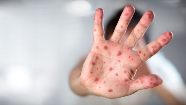 ΕΟΔΥ: Τρεις επιδημίες ιλαράς στην Ελλάδα την τελευταία 20ετία, με 4.151 κρούσματα και 4 θανάτους