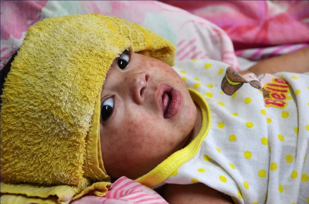 Μαγιορκίνης: Εκτεθειμένοι στην ιλαρά όσοι δεν έχουν ολοκληρώσει τον εμβολιασμό