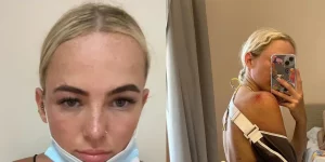 Κέρκυρα: Τρομακτικό τροχαίο με γουρούνα – «Είμαι τυχερή που ζω»