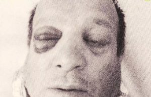 Αλεξανδρούπολη: «Με ξέχασαν όλοι» – Η εξομολόγηση του αστυνομικού μετά την επίθεση με τσεκούρι