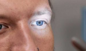 Επιπεφυκίτιδα: Πότε οφείλεται σε αλλεργία και πότε σε λοίμωξη;