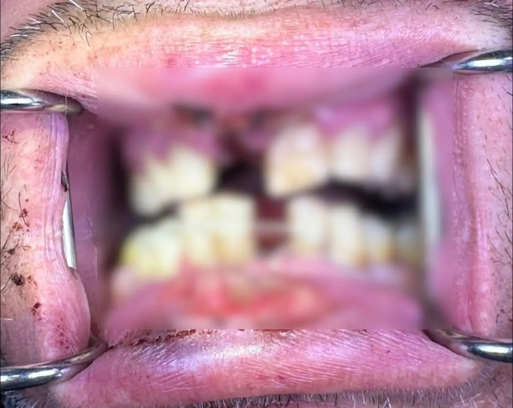 Κρήτη: «Έσκασε» ηλεκτρονικό τσιγάρο την ώρα που το είχε στο στόμα του