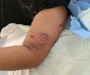 Πέραμα: Επίθεση σκύλου σε 12χρονο – «Το παιδί έχει σοβαρά τραύματα» δηλώνει στα «ΝΕΑ» η δικηγόρος της οικογένειας