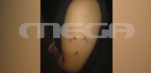 Άγρια επίθεση σκύλου σε 12χρονο παιδί στο Πέραμα – Μεταφέρθηκε στο Παίδων