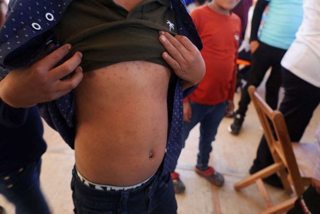 Η ιλαρά επιμένει παρά τη μείωση κρουσμάτων το 2025 στην ΕΕ