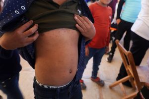 Η ιλαρά επιμένει παρά τη μείωση κρουσμάτων το 2025 στην ΕΕ