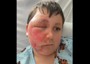 Εννιάχρονος στο Ιλινόις υπέστη σοβαρά εγκαύματα στο κεφάλι συμμετέχοντας σε επικίνδυνο challenge στο TikTok