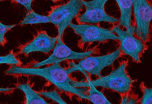 Θεραπεία – δούρειος ίππος για τον καρκίνο δίνει ελπίδες για την καταπολέμησή του