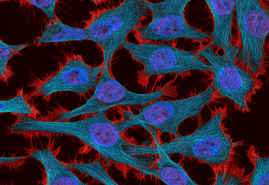 Θεραπεία – δούρειος ίππος για τον καρκίνο δίνει ελπίδες για την καταπολέμησή του