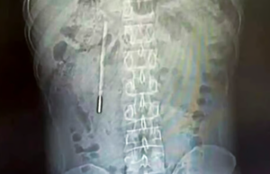 Σοκ: 32χρονος ζούσε επί 20 χρόνια με θερμόμετρο υδραργύρου στο στομάχι