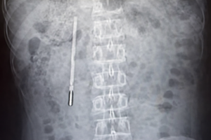 Σοκ: 32χρονος ζούσε επί 20 χρόνια με θερμόμετρο υδραργύρου στο στομάχι