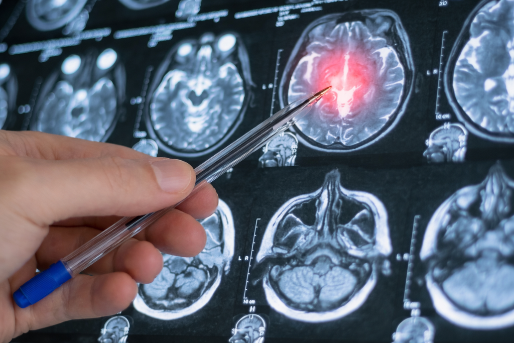 Τι είναι η ρήξη ανευρύσματος εγκεφάλου – Αιτίες και κίνδυνοι