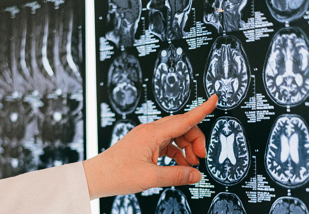 Η επιστήμη επιβεβαιώνει: Νέα εξέταση εντοπίζει την άνοια χρόνια πριν εμφανιστούν συμπτώματα