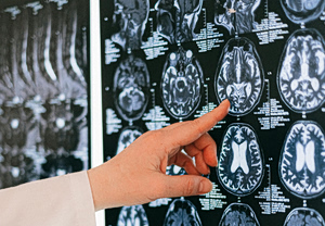 Η επιστήμη επιβεβαιώνει: Νέα εξέταση εντοπίζει την άνοια χρόνια πριν εμφανιστούν συμπτώματα